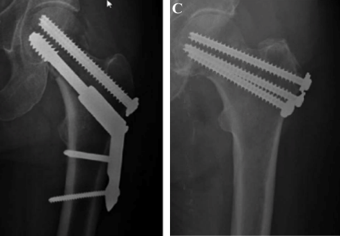 Fracture du col du fémur Hôpital DCSS